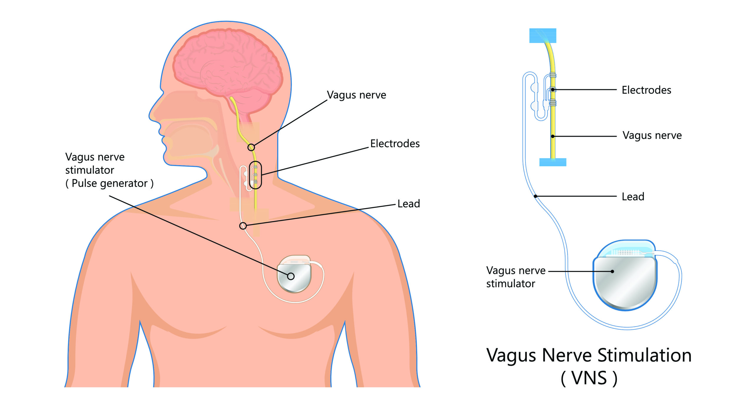 Vagal Nerve Stimulation